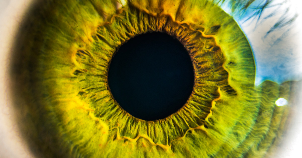 Eye pupil with Benign Essential Belpharospasm